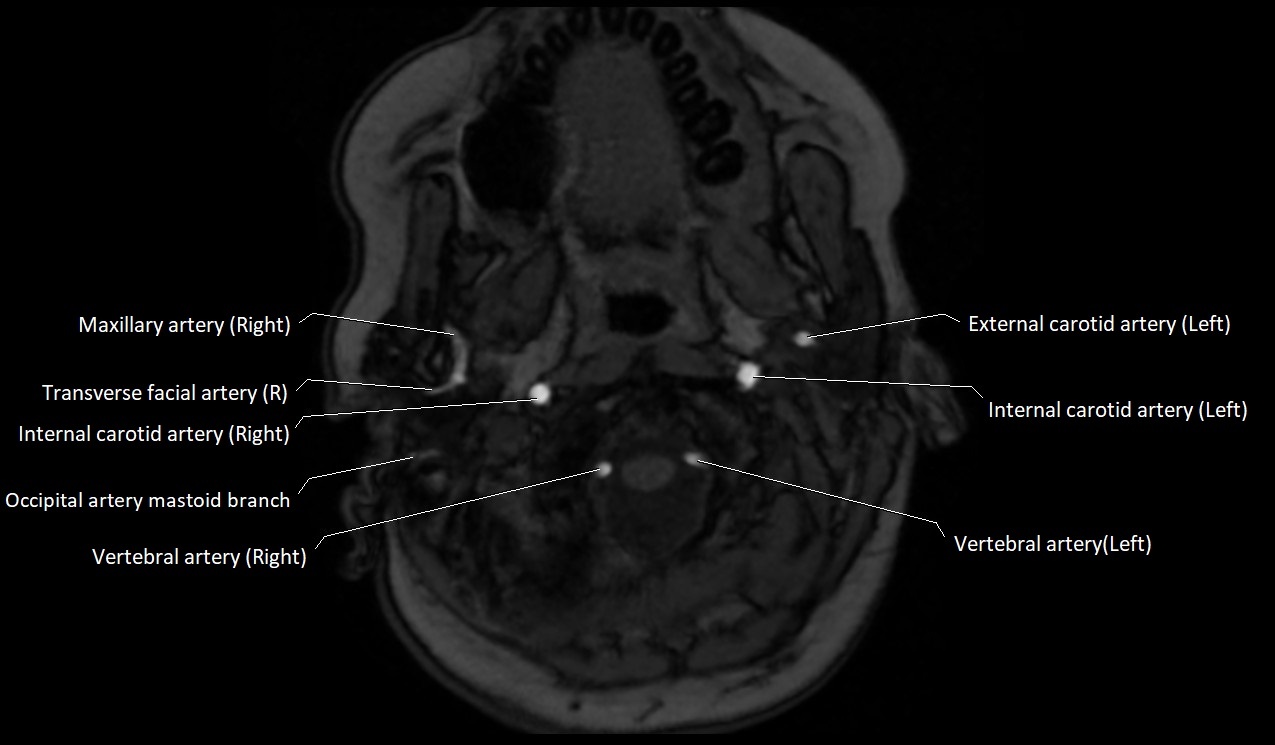 Carotid artery anatomy axial 3T image 7.jpg